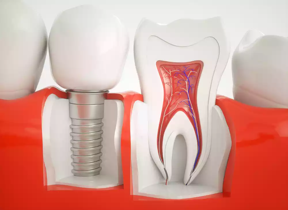Implantes 0