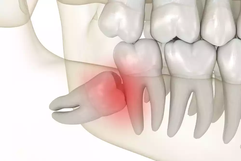cirugia molares (5)