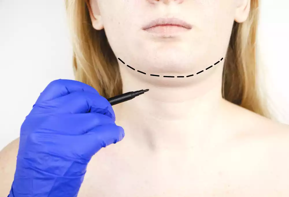 mentoplasty 3