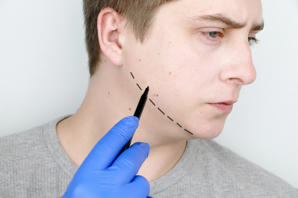 mentoplasty 4
