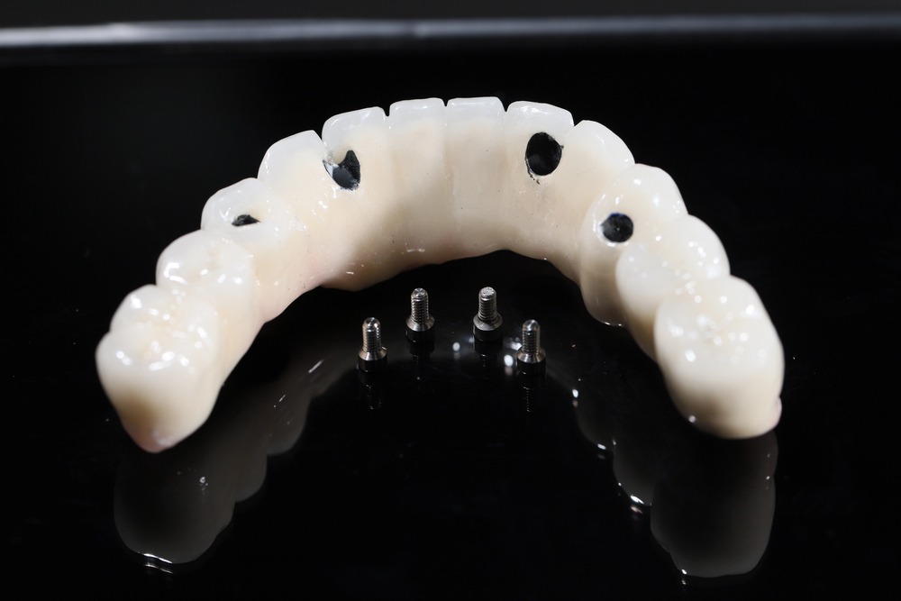 Zygomatic Implants