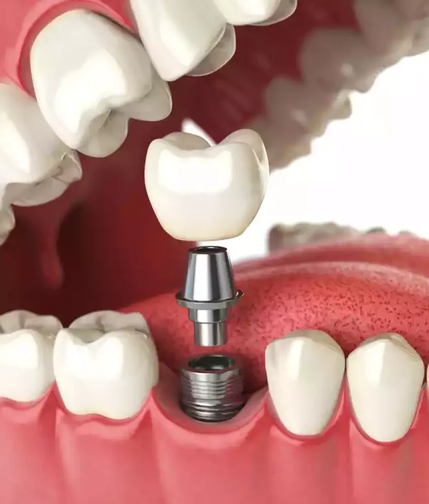Implantes (1)