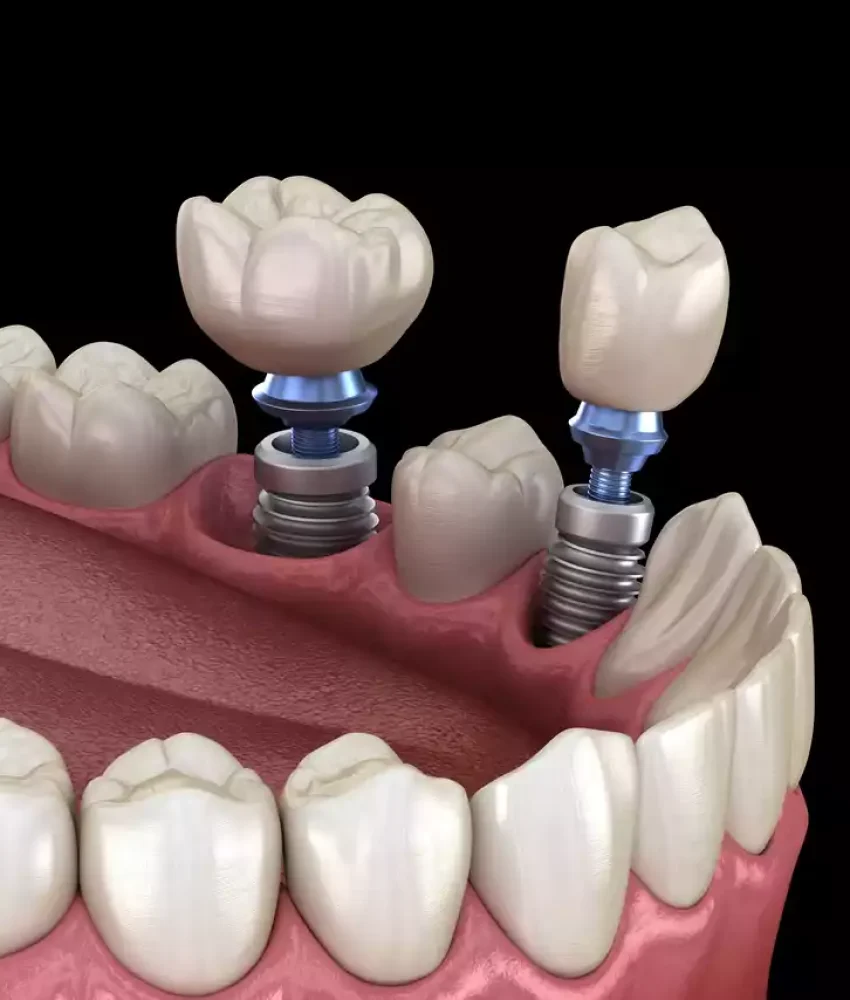 Implantes (2)